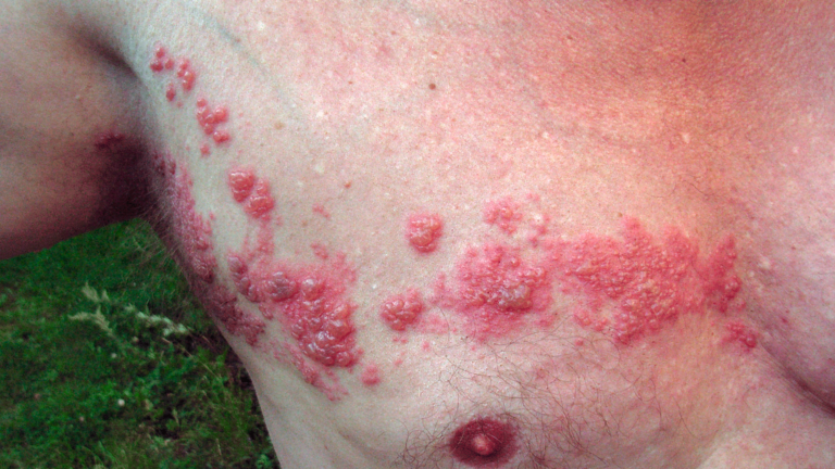 Herpes Zoster no peito