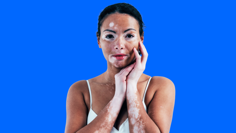 Mulher com vitiligo