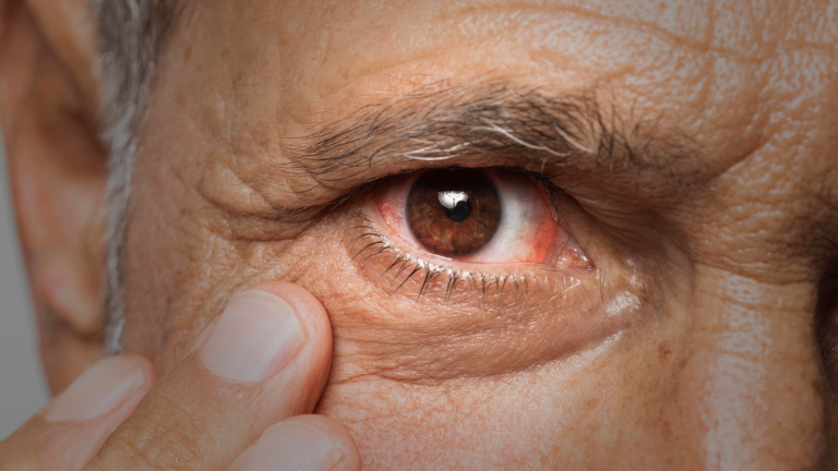 Paciente idoso com retinopatia hipertensiva